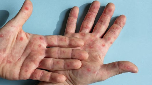 Detectaron dos nuevos casos de viruela símica en Córdoba