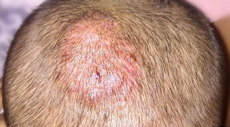 Se propaga una epidemia silenciosa de verano: cómo prevenir la tiña capilar