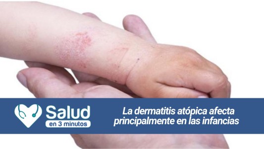 Dermatitis Atópica