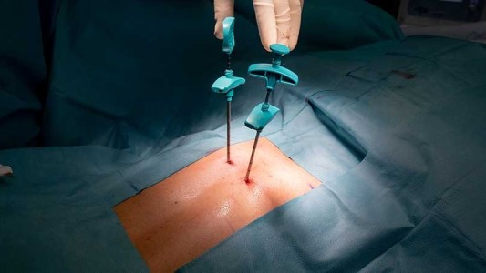 Avance en salud pública: Córdoba incorpora cirugías endoscópicas de columna