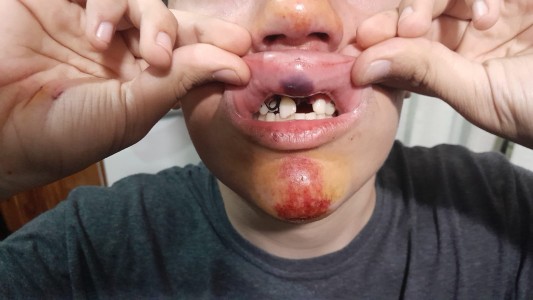 Iba a comprar y lo empujaron para robarle: perdió dos dientes