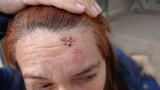 La golpearon hasta abrirle la cabeza para robarle el celular en barrio Carrara de Horizonte Norte