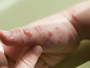 Detectan en Argentina el primer caso de una variante más contagiosa de viruela del mono