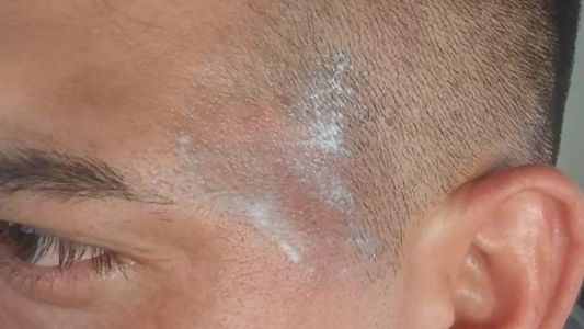 Arrojaron agua hirviendo a un policía durante un operativo y se detuvieron a dos personas