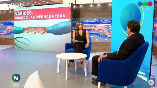 Várices, cuando las piernas pesan