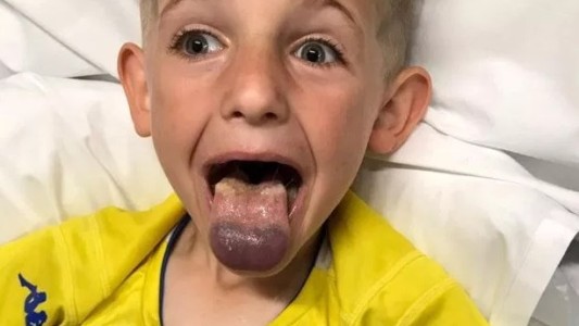 Un nene estuvo al borde de la muerte al atascarse la lengua en una botella de plástico