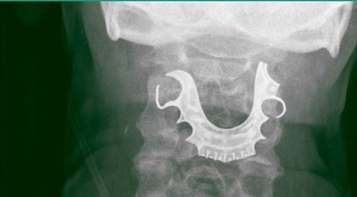 El hombre que vivió 8 días con su dentadura postiza en la garganta