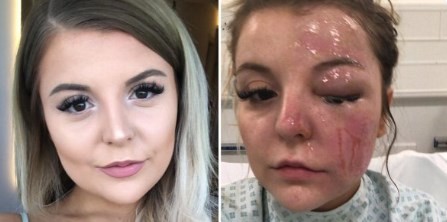 Hacía un huevo duro en el microondas, le explotó y así le quedó la cara