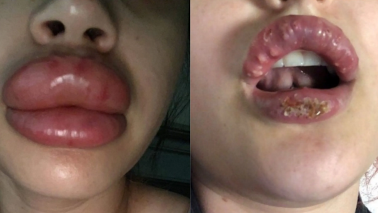 Quisieron pagar menos por un retoque estético y así le quedaron los labios