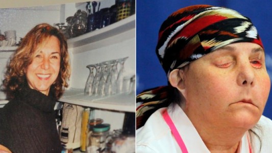 Su marido la quemó con ácido, le hicieron un trasplante de cara y ahora su cuerpo rechaza el nuevo rostro