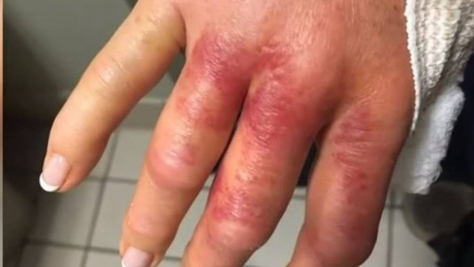 Fue por una sesión de manicura y casi pierde la mano por la bacteria "come carne"