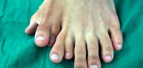 Nació con 9 dedos en uno de sus pies y no lo operaban porque creían que era buena suerte