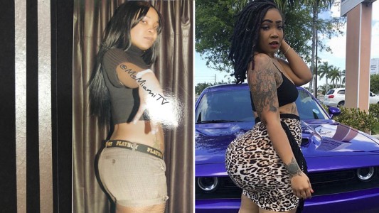 Abusó de las cirugías estéticas y ahora los médicos le advirtieron que tendrán que amputarle los glúteos