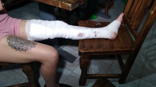 Feroz ataque a una chica: dos mujeres le abrieron toda la pierna con una botella rota