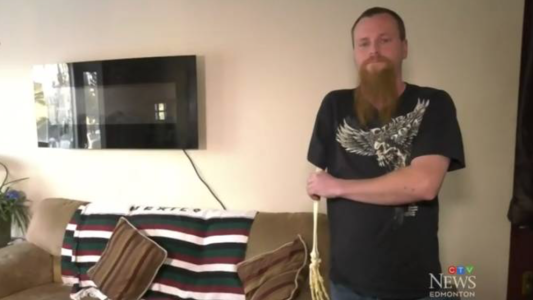 El hombre al que le amputaron un brazo por un accidente y conservó el esqueleto de recuerdo