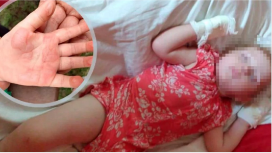 Impactantes imágenes de las quemaduras que recibió una nena en el puente de Carlos Paz