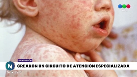 Alerta por sarampión, cómo evitar que llegue a Córdoba
