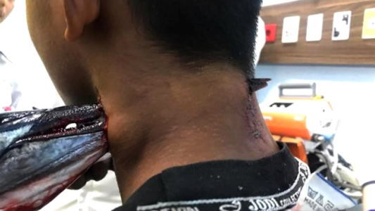 Estaba pescando y un pez espada se le clavó en el cuello: se salvó de milagro