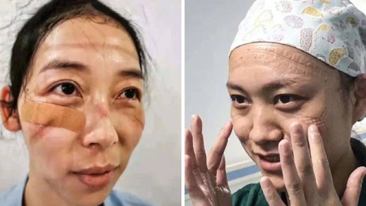IMÁGENES SENSIBLES: las marcas en la cara de las enfermeras chinas que luchan contra el coronavirus