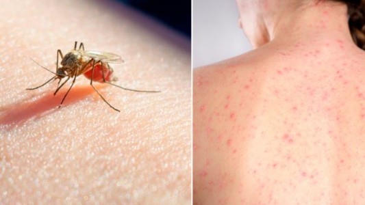 Confirman la muerte de una mujer por sarampión y la de un hombre por dengue