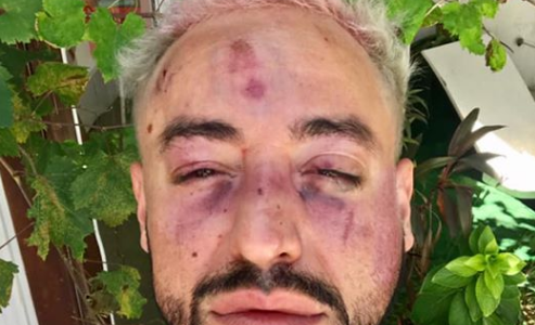 Brutal ataque homofóbico de una patota a un joven diseñador