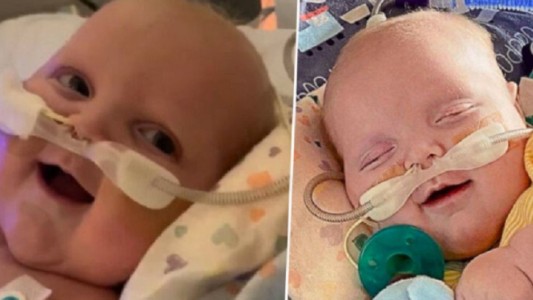 Foto conmovedora: la primera sonrisa de un bebé que fue operado dos veces del corazón
