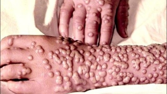 Antecedentes de grandes pandemias que sacudieron a la humanidad y las más mortífera