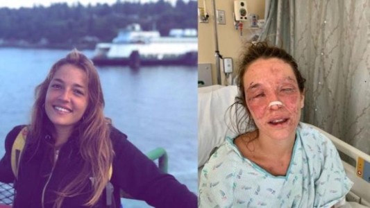 Intentó hacer jabón con un tutorial de Internet y se quemó los ojos