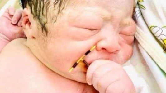 Un bebé nació con el DIU de su madre en la mano