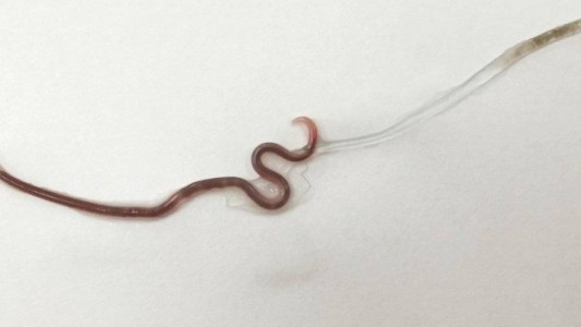 Comió sashimi en mal estado y le creció un gusano en la garganta