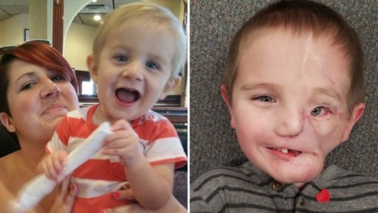 El nene que intenta reconstruir su vida luego de que 2 rotweilers le desfiguraron la cara