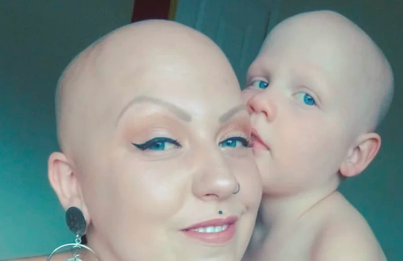 Madre e hija que sufren alopecia se sacan una selfie para luchar contra los complejos