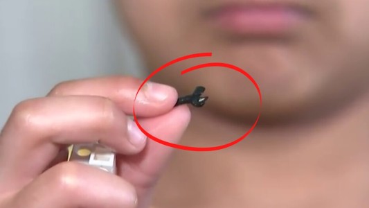 El nene de 7 años que vivió dos años con una pieza de Lego en la nariz