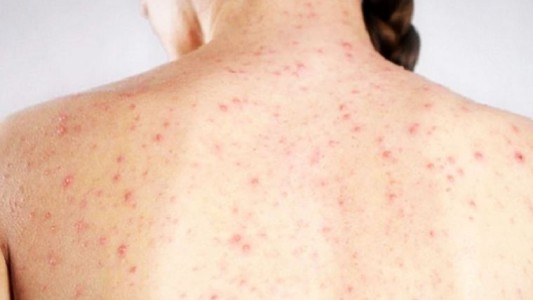 Argentina dio por terminado el brote de sarampión y lo informó a la OMS