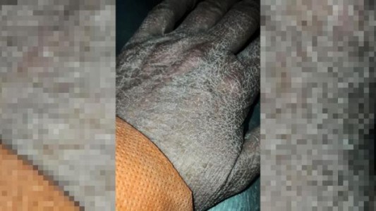 Se viralizó la imagen de la mano de una enfermera luego de horas de trabajo