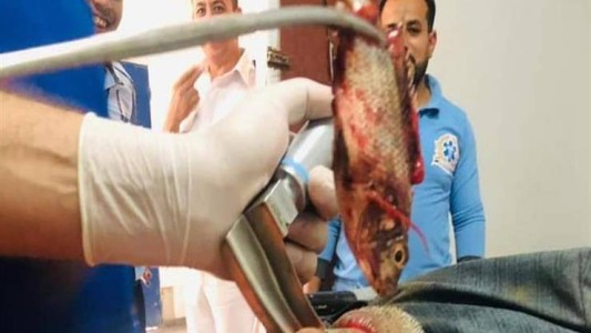Operación de urgencia: debieron sacarle de la garganta un pez vivo que tragó por accidente