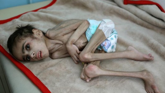 El drama de un nene de Yemen que pesa sólo 7 kilos y tiene parálisis cerebral