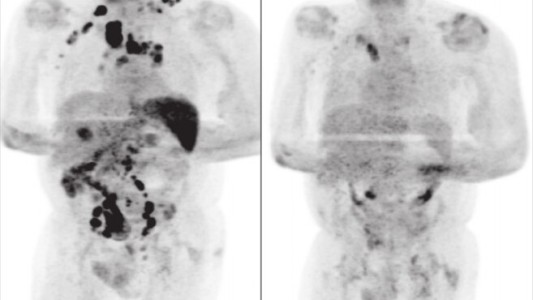 Investigan el caso de un hombre que se curó de cáncer tras contagiarse coronavirus