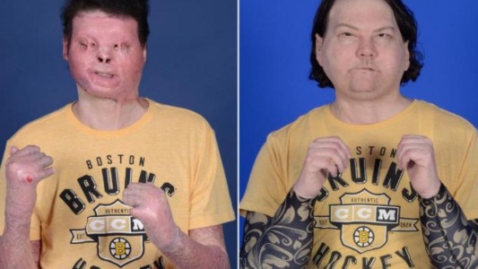 Primer trasplante de cara y manos en simultáneo