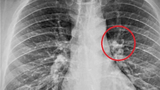 Se enteró por la radiografía que se había tragado un auricular mientras dormía