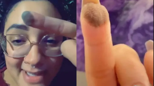 El extraño caso de una mujer que le crece vello púbico en un dedo a causa de un injerto de piel