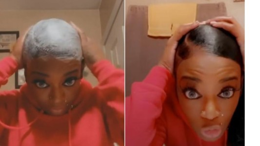 "Mala idea": se le terminó el gel, usó pegamento para peinarse y ahora debe operarse