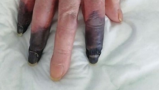 Una mujer perdió 3 dedos por la gangrena que le provocó el coronavirus
