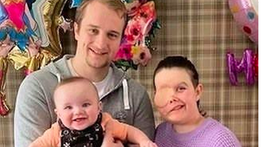 Una joven madre descubrió que tenía un raro tipo de cáncer porque le lloraba un ojo