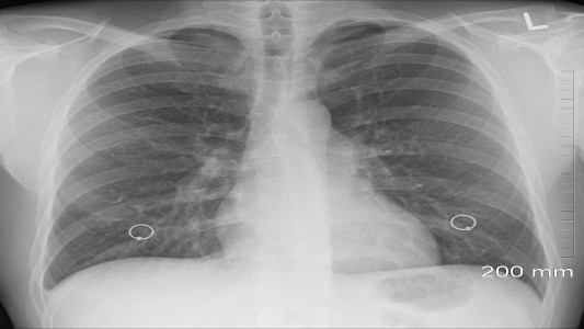 Le diagnosticaron tuberculosis y meses después confesó que el problema era que se había tragado un preservativo