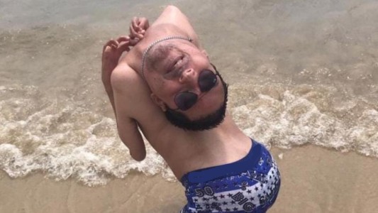 El hombre que nació con la cabeza al revés se contagió de coronavirus