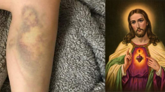 Se cayó de la bicicleta y le salió un moretón con la cara de Jesús