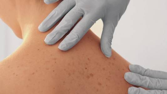 Presentan tecnología israelí para diagnosticar cáncer de piel en segundos