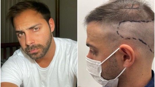 Grego Rosello mostró el proceso de su implante capilar: “Lo ideal sería aceptarnos como somos, pero es jodido”