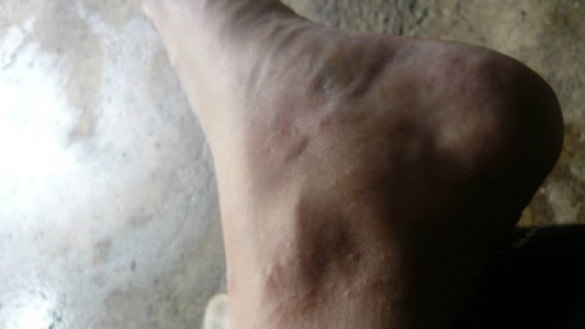 Contrajo tres enfermedades diferentes tras una picadura